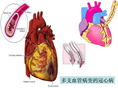 常見病冠心病