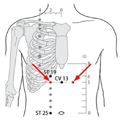 承滿穴→治胃痛、胃痙攣