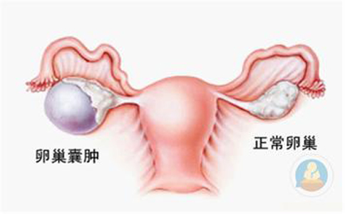 卵巢囊腫，抱腿壓涌泉穴，給你愛心呵護