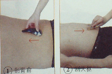 潰瘍性結(jié)腸炎—刮痧