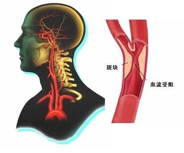 腦動脈硬化